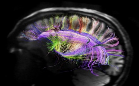 Οι πολλές εγκεφαλικές συνάψεις αιτία για σχιζοφρένεια και αυτισμό